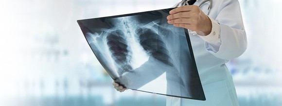 Doctor examining chest x-ray